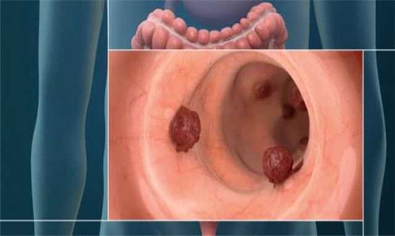 غربالگری تاکنون 14 هزار یزدی برای سرطان روده بزرگ