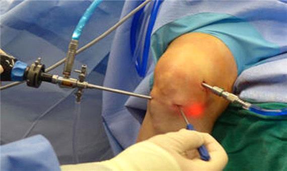 عمل جراحی ارتروسکوپی زانو برای نخستین بار در بافق انجام شد