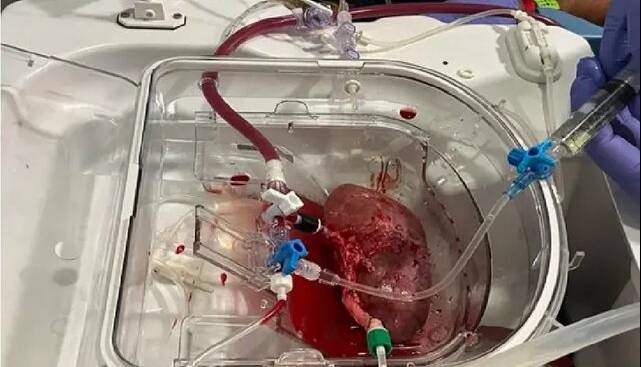 پیوند اولین کلیه هیبریدی انسان-خوک در اسپانیا