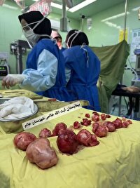 خروج ۲۴ میوم از رحم بیمار ۳۸ ساله در خاتم