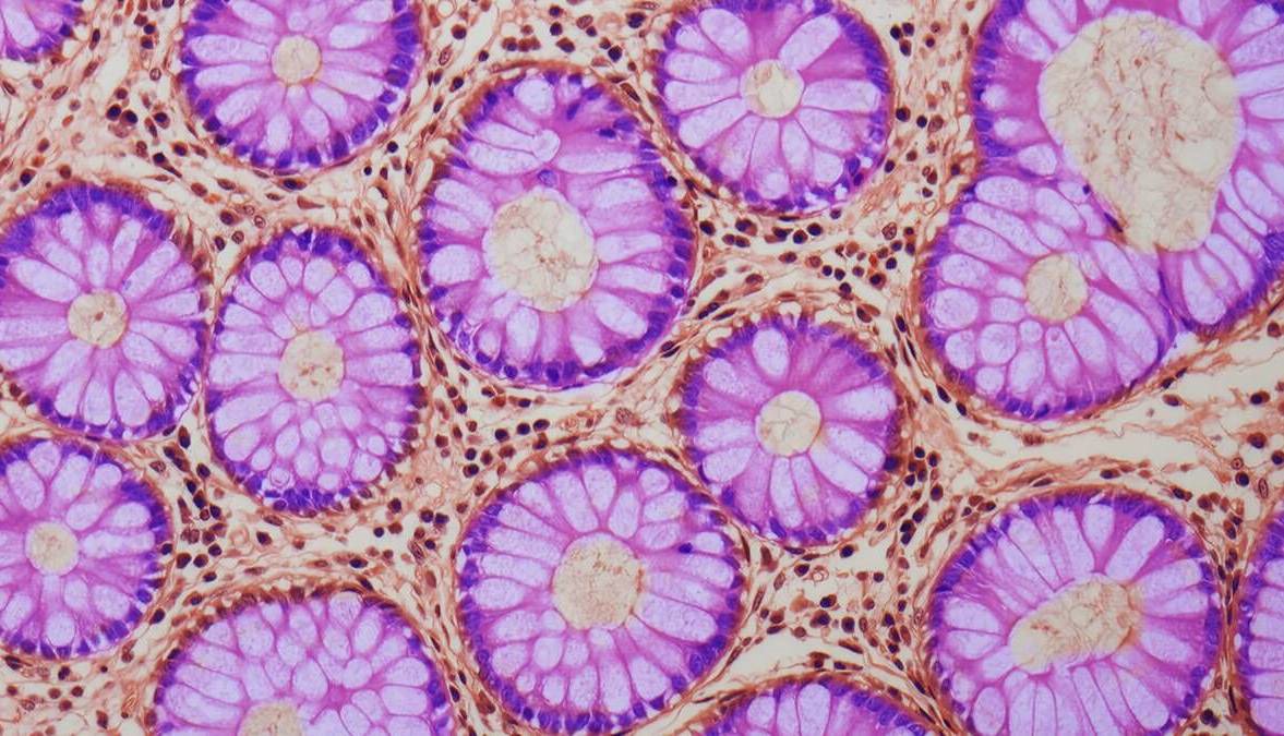 چگونه التهاب و کمبود آهن رانش پیری در روده را تسریع می‌کند